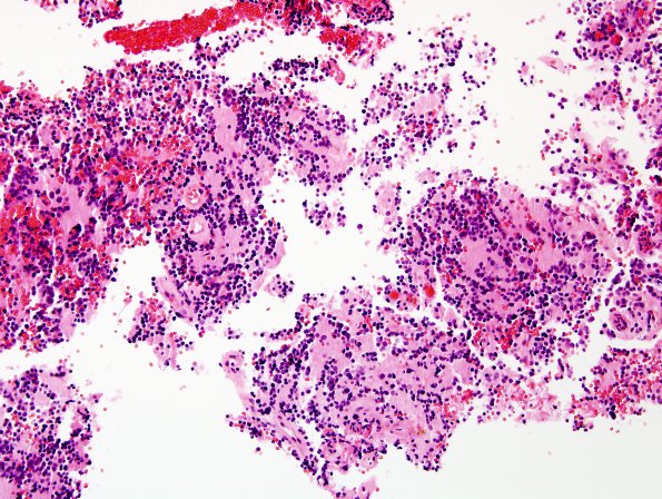 2B3 Pineocytoma (Case 2) H&E 5.jpg