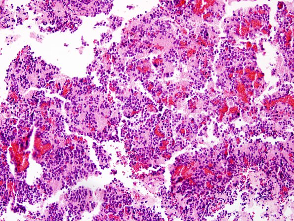 2B4 Pineocytoma (Case 2) H&E 6.jpg