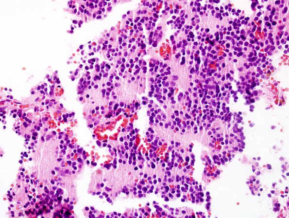 2B5 Pineocytoma (Case 2) H&E 1.jpg