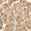 Neurofilament immunohistochemistry stains the cytoplasm of individual tumor cells and their processes. (NF IHC)