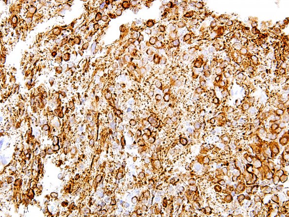 Neurofilament immunohistochemistry stains the cytoplasm of individual tumor cells and their processes. (NF IHC)