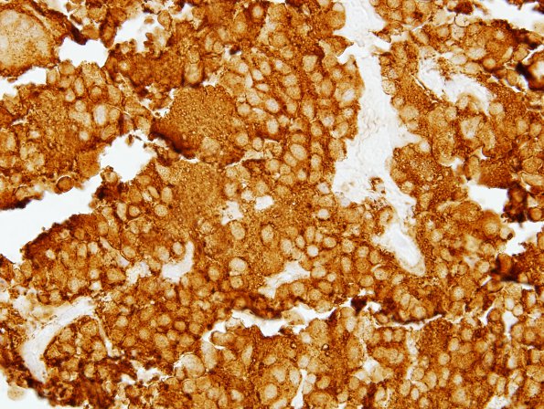 2D2 Pineocytoma (Case 2) SYN 4.jpg