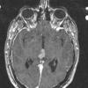 3A Pineocytoma (Case 2) T1 W 1 - Copy