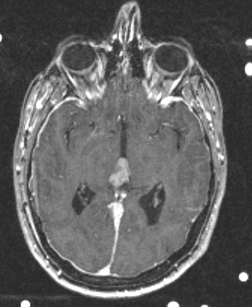 3A Pineocytoma (Case 2) T1 W 1 - Copy