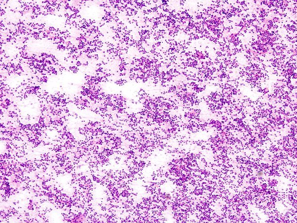 3B1 Pineocytoma (Case 3) H&E smear 5.jpg