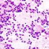 3B2 Pineocytoma (Case 3) H&E smear 2 copy.jpg