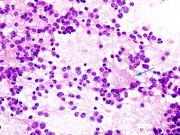 3B2 Pineocytoma (Case 3) H&E smear 2 copy.jpg