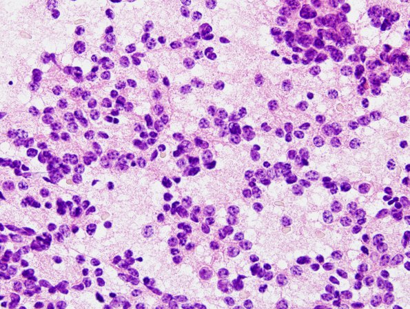 3B3 Pineocytoma (Case 3) H&E smear 3.jpg