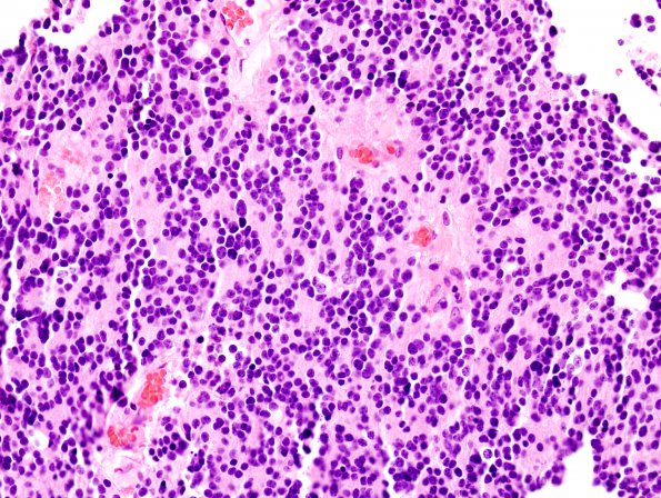 3B5 Pineocytoma (Case 3) H&E 7.jpg