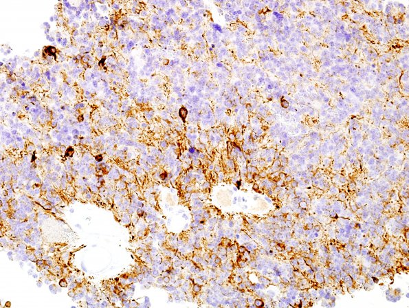 3C1 Pineocytoma (Case 3) NF 7.jpg