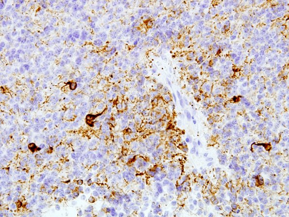 3C2 Pineocytoma (Case 3) NF 5.jpg