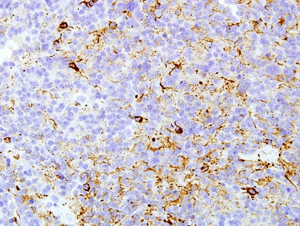 3C3 Pineocytoma (Case 3) NF 2.jpg