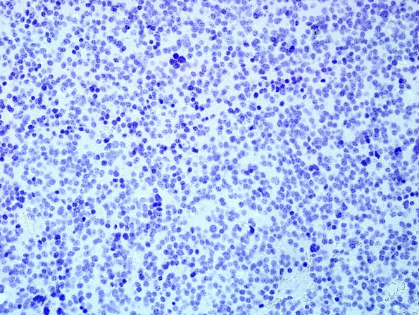 3E Pineocytoma (Case 3) NeuN 2.jpg