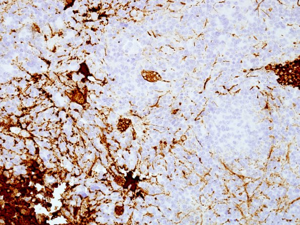 3F1 Pineocytoma (Case 3) GFAP 3.jpg