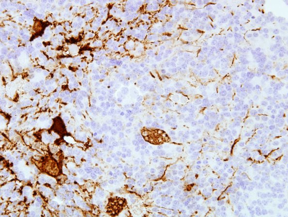 3F2 Pineocytoma (Case 3) GFAP 7.jpg