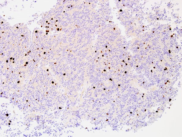 3G Pineocytoma (Case 3) Ki67 3.jpg