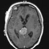 4A1 Pineocytoma (Case 4) T1noC - Copy