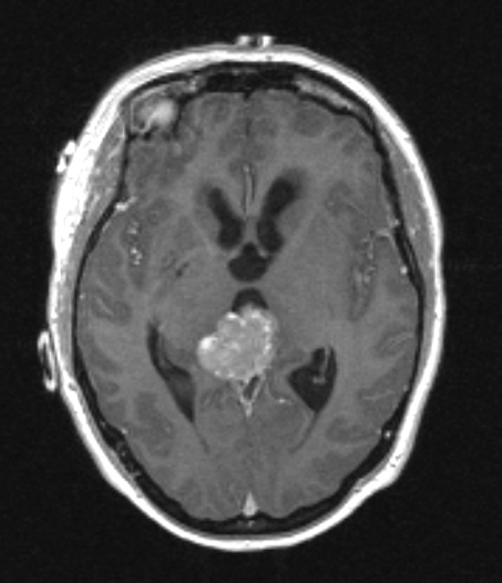 4A1 Pineocytoma (Case 4) T1noC - Copy