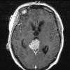 4A2 Pineocytoma (Case 4) T1W - Copy