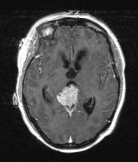 4A2 Pineocytoma (Case 4) T1W - Copy