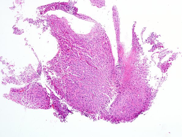 4B1 Pineocytoma (Case 4) H&E 3.jpg