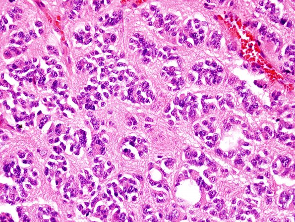 4B2 Pineocytoma (Case 4) H&E 5.jpg