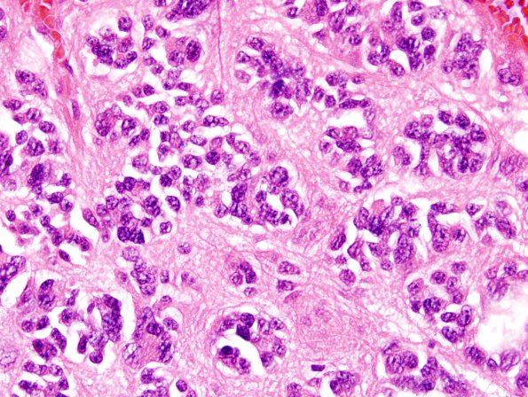 4B3 Pineocytoma (Case 4) H&E 6.jpg