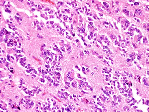 4B4 Pineocytoma (Case 4) H&E 8.jpg