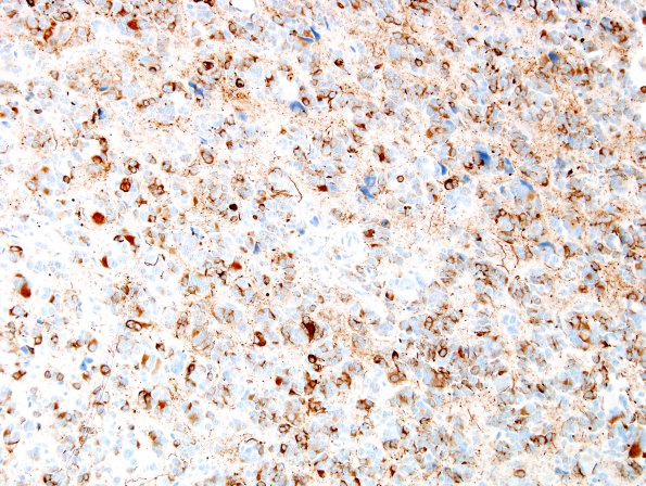 4C1 Pineocytoma (Case 4) NF 3.jpg