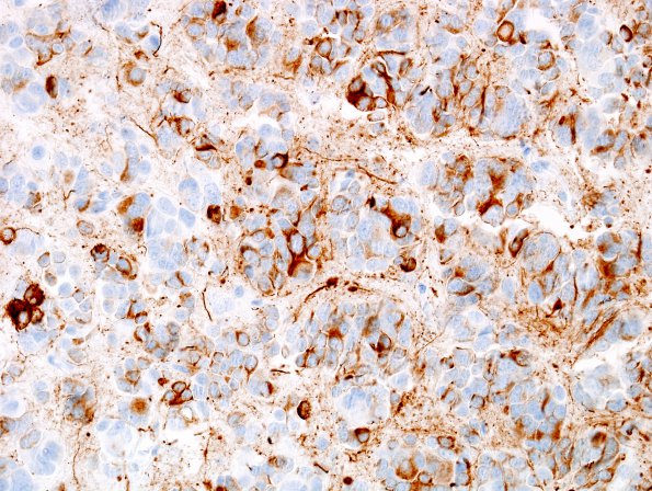 4C2 Pineocytoma (Case 4) NF 5.jpg