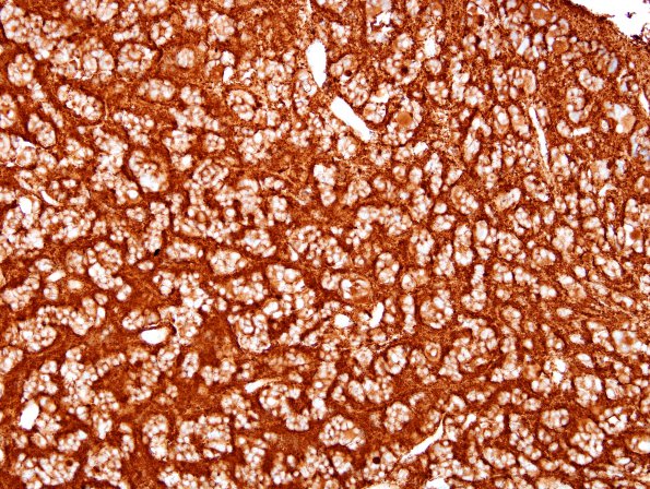 4D1 Pineocytoma (Case 4) SYN 3.jpg