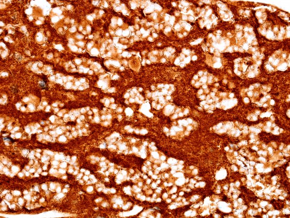 4D2 Pineocytoma (Case 4) SYN 2.jpg