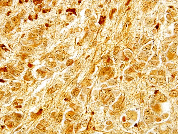 4E2 Pineocytoma (Case 4) Biels 2.jpg