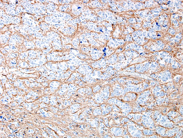 4F1 Pineocytoma (Case 4) GFAP 2.jpg