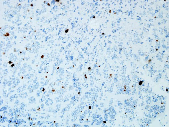 4G Pineocytoma (Case 4) Ki67 1.jpg