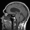 5A1 Pineocytoma (Case 5) T1 IPAT noC - Copy