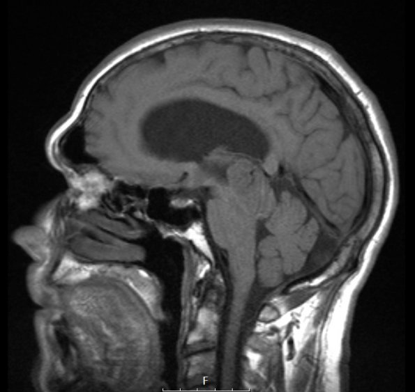 5A1 Pineocytoma (Case 5) T1 IPAT noC - Copy