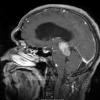 5A2 Pineocytoma (Case 5) T1 FS With contrast - Copy