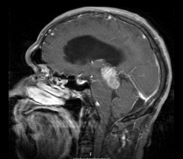 5A2 Pineocytoma (Case 5) T1 FS With contrast - Copy