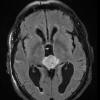 5A3 Pineocytoma (Case 5) FLAIR - Copy