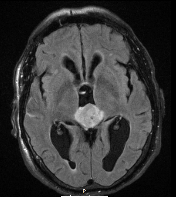 5A3 Pineocytoma (Case 5) FLAIR - Copy