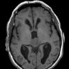 5A4 Pineocytoma (Case 5) T1 noC 2 - Copy