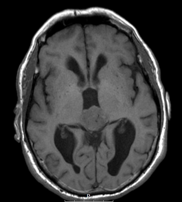 5A4 Pineocytoma (Case 5) T1 noC 2 - Copy