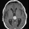 5A5 Pineocytoma (Case 5) T1 W - Copy