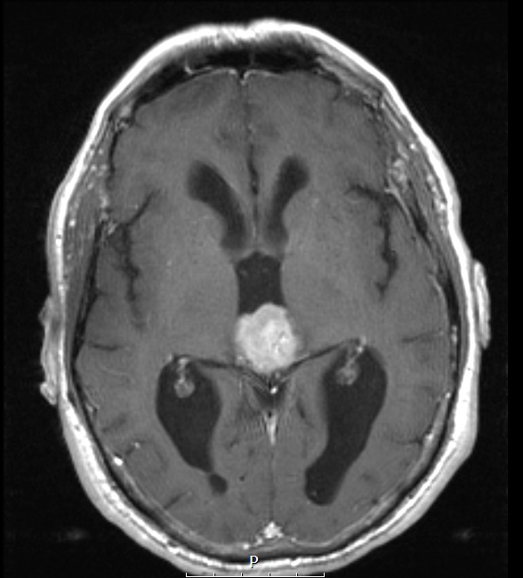 5A5 Pineocytoma (Case 5) T1 W - Copy