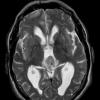 5A6 Pineocytoma (Case 5) T2 W - Copy