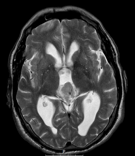 5A6 Pineocytoma (Case 5) T2 W - Copy