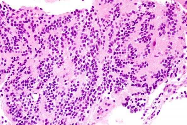 5B1 Pineocytoma (Case 5) H&E 3.jpg