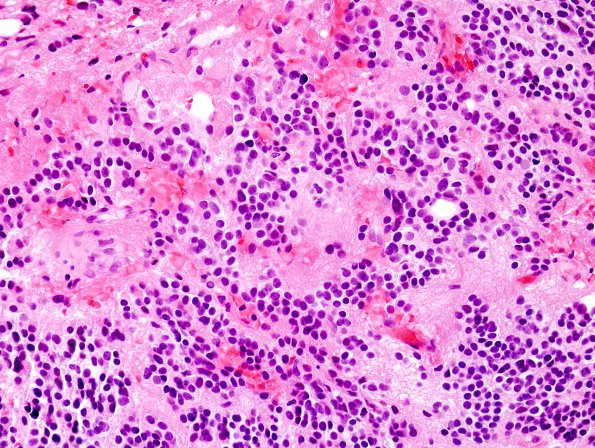 5B2 Pineocytoma (Case 5) H&E 4.jpg