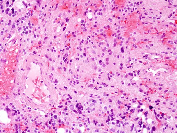 5B4 Pineocytoma (Case 5) H&E 1.jpg